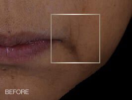 Helena Rubinstein: -11% reduction in nasolabial folds after 28 days, visibly smoother skin.