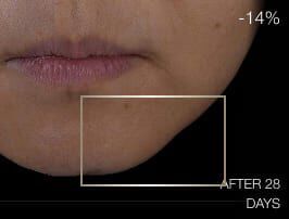 Close-up of lower face before treatment, showing signs of skin laxity and lack of definition around the jawline.
